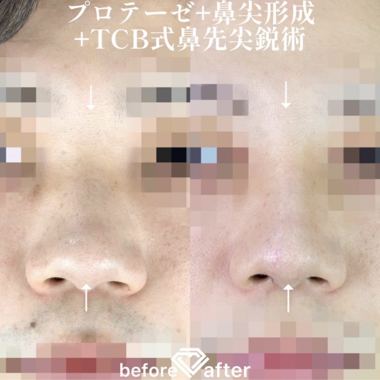 鼻プロテーゼ（隆鼻術）(担当医:森本 理一郎 医師)の症例写真4