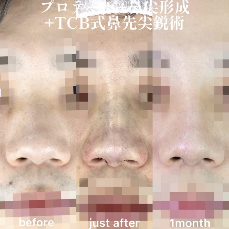 鼻プロテーゼ（隆鼻術）(担当医:森本 理一郎 医師)の症例写真1