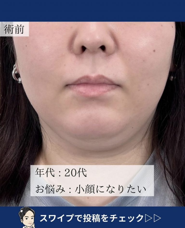 TCB式小顔脂肪吸引(担当医:宗像 寿祥 医師)の症例写真2