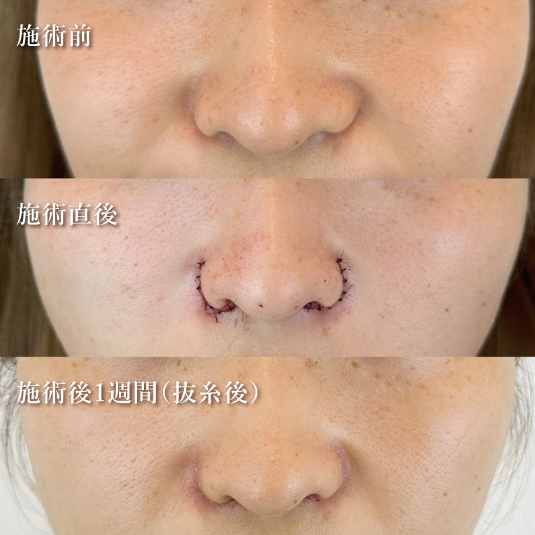 TCB式鼻翼縮小完全内側法(担当医:松元 宗一郎 医師)の症例写真2