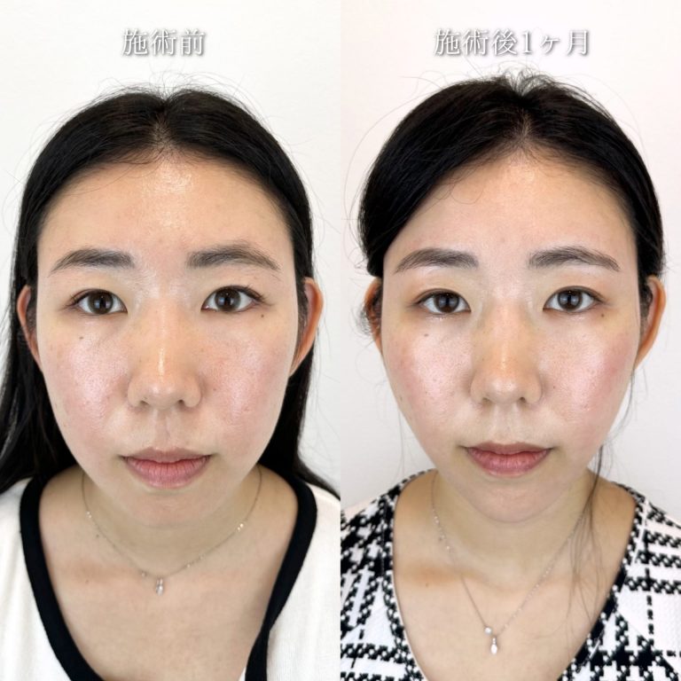小顔美肌再生（リフトアップ）(担当医:TCB 医師)の症例写真1