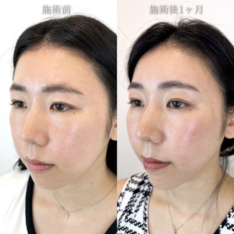 小顔美肌再生（リフトアップ）(担当医:TCB 医師)の症例写真2