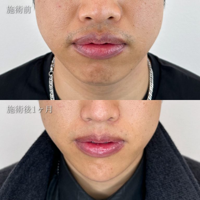 TCB式小顔脂肪吸引(担当医:松元 宗一郎 医師)の症例写真1