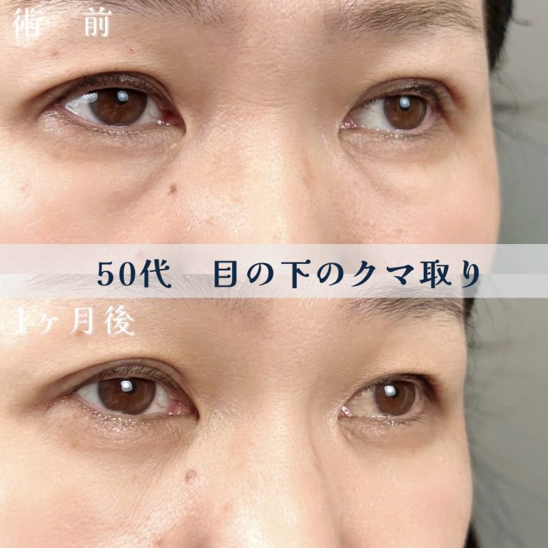 切らない目の下のクマ取り・目の下のたるみ（ふくらみ）取り(担当医:佐藤 光 医師)の症例写真1