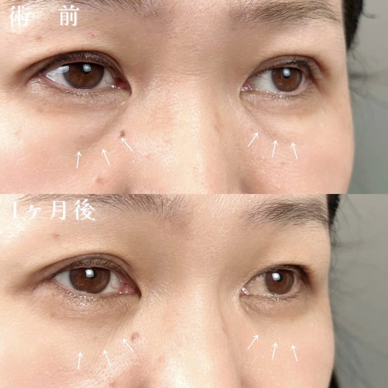 切らない目の下のクマ取り・目の下のたるみ（ふくらみ）取り(担当医:佐藤 光 医師)の症例写真2