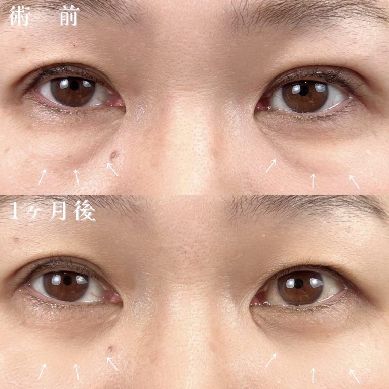 切らない目の下のクマ取り・目の下のたるみ（ふくらみ）取り(担当医:佐藤 光 医師)の症例写真4