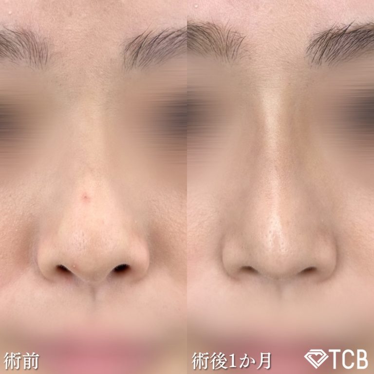 TCB式鼻先尖鋭術（だんご鼻解消）(担当医:奥田 真吾 医師)の症例写真1