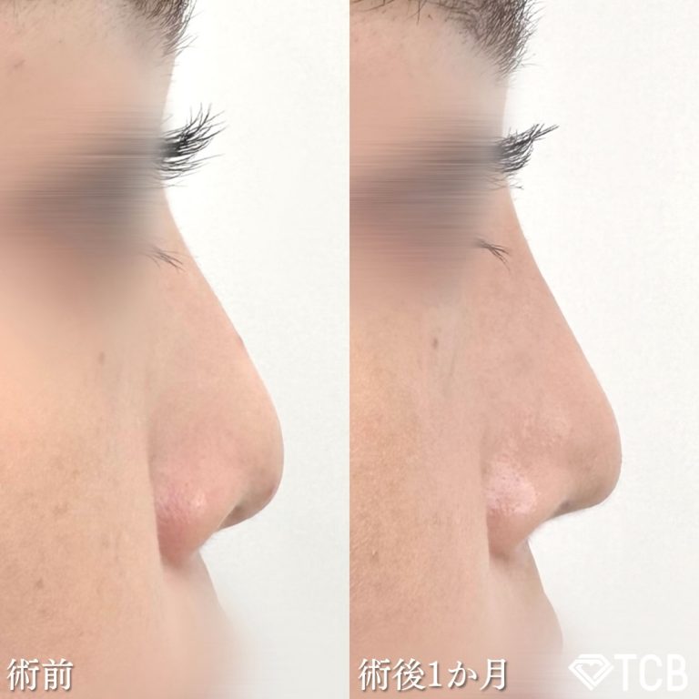 TCB式鼻先尖鋭術（だんご鼻解消）(担当医:奥田 真吾 医師)の症例写真3