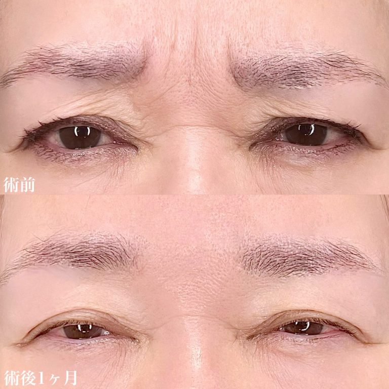 眉間のしわ治療（ボトックス）(担当医:TCB 医師)の症例写真1
