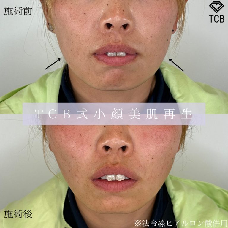 TCB式小顔美肌再生(担当医:寺尾 紗世 医師)の症例写真1