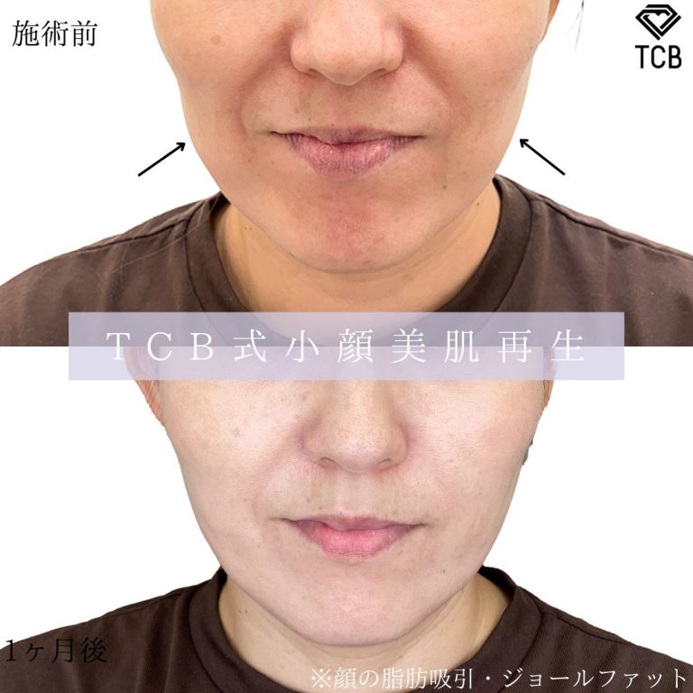 TCB式小顔美肌再生(担当医:寺尾 紗世 医師)の症例写真1