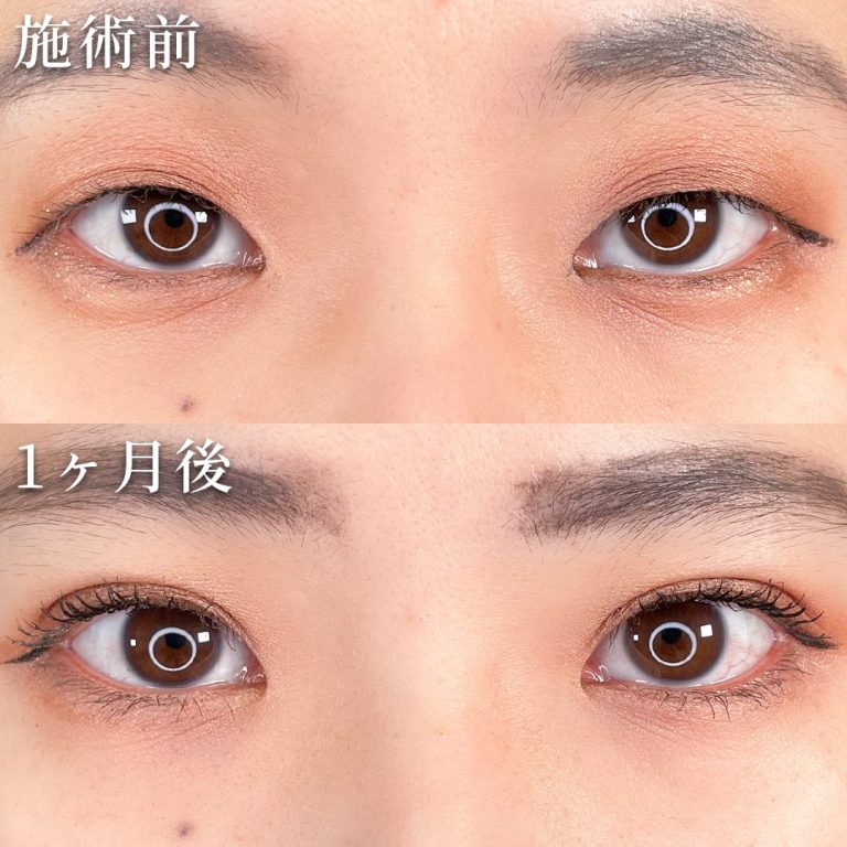 二重埋没法(担当医:TCB 医師)の症例写真1