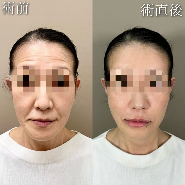 TCB式小顔美肌再生(担当医:中村 杏奈 医師)の症例写真2
