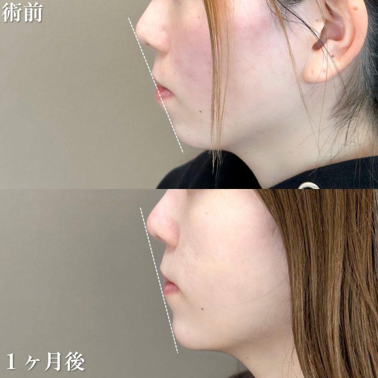 切らない顎形成 3D Eライン(担当医:渡邉 正士 医師)の症例写真4
