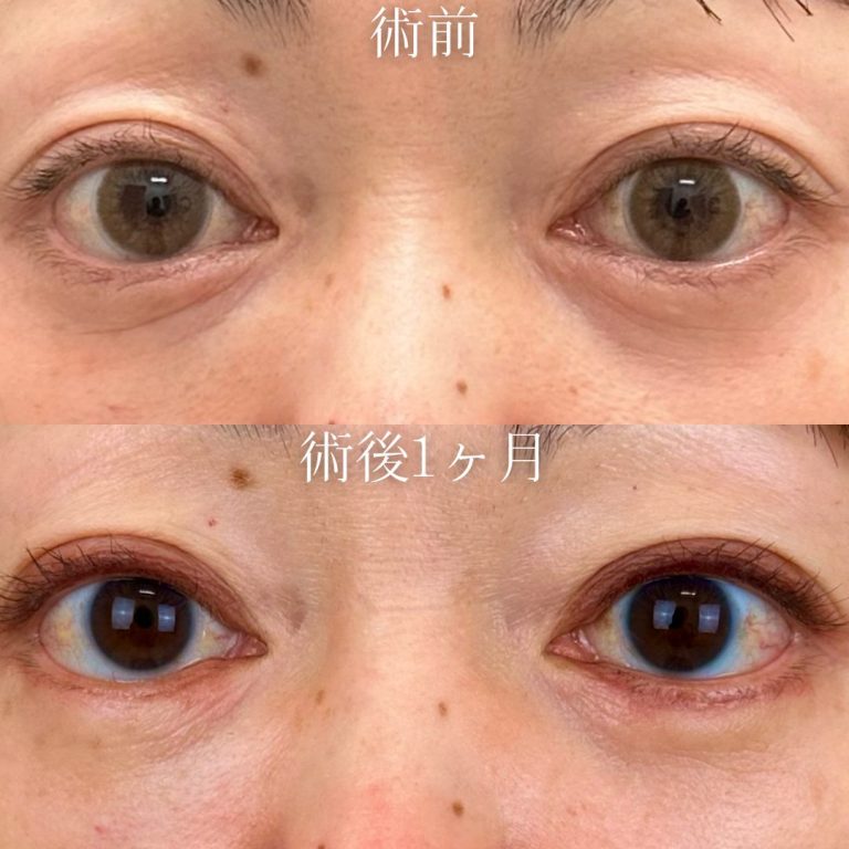 切開法による目の下のたるみ取り（下眼瞼除皺術）(担当医:田中 誉大 医師)の症例写真1