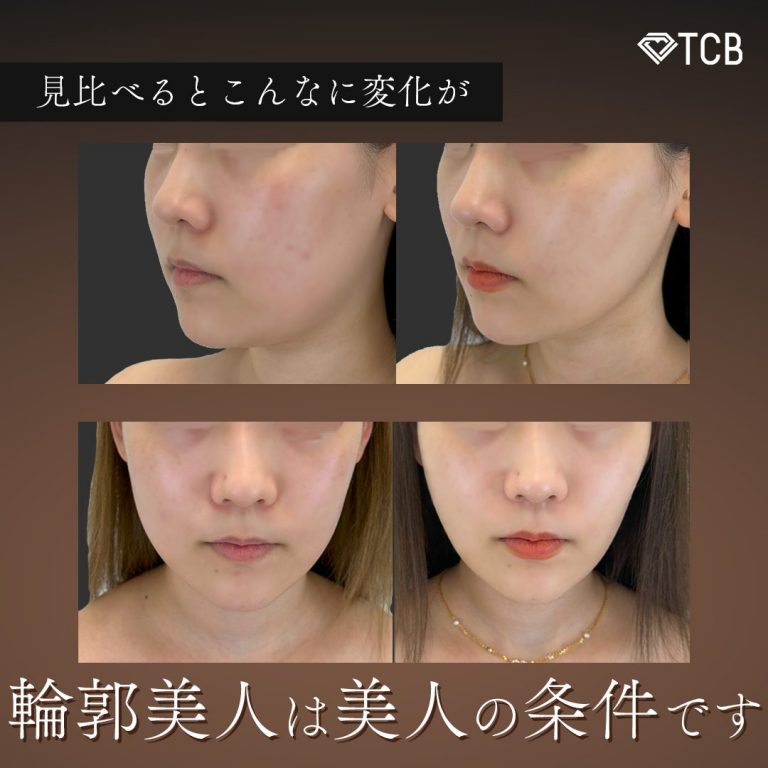 TCB式小顔脂肪吸引(担当医:鎌田 紀美子 医師)の症例写真4