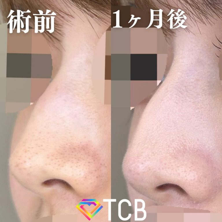 TCBメッシュ(担当医:大隈 宏通 医師)の症例写真1