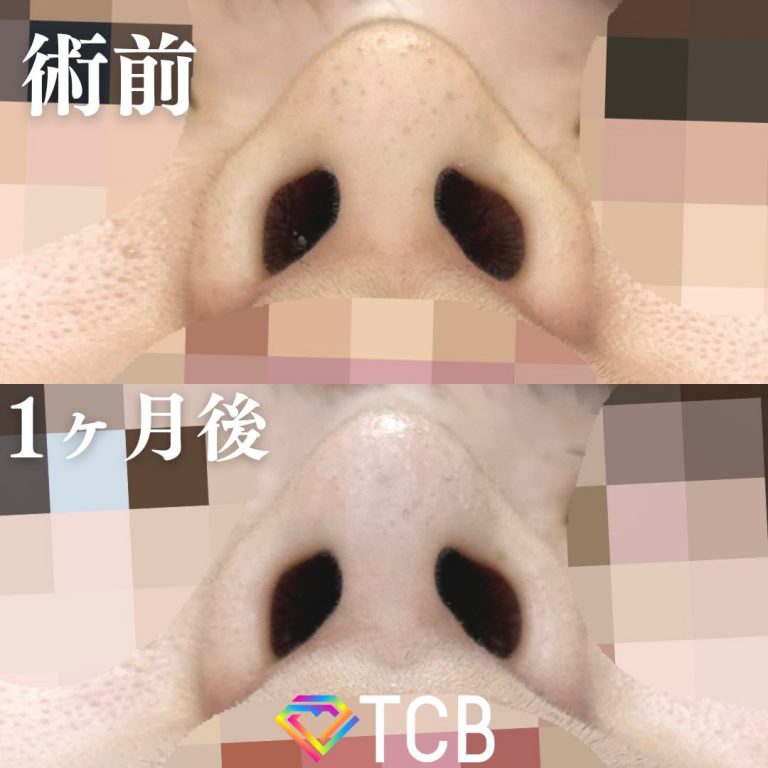 TCBメッシュ(担当医:大隈 宏通 医師)の症例写真3