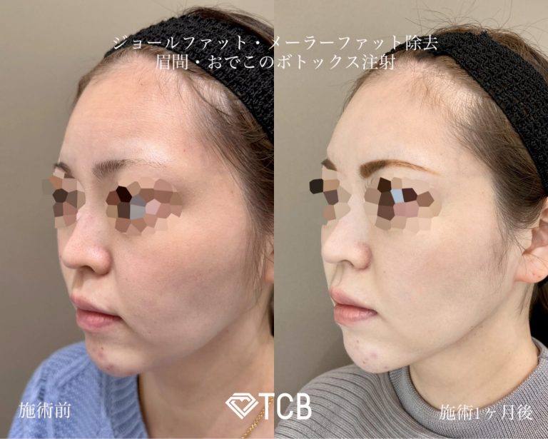 TCB式小顔脂肪吸引(担当医:寺西 宏王 医師)の症例写真1
