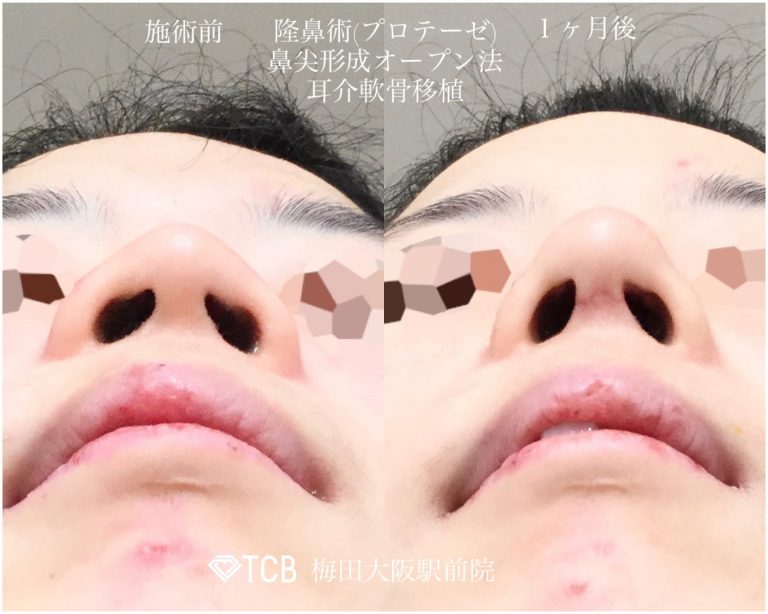 鼻プロテーゼ（隆鼻術）(担当医:寺西 宏王 医師)の症例写真1
