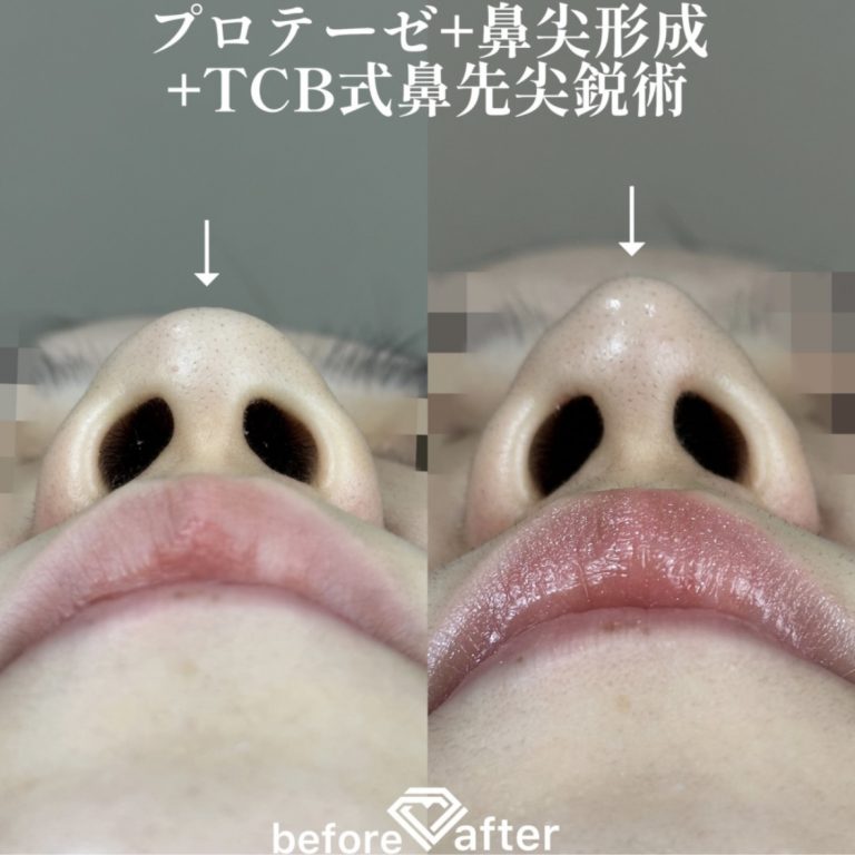 鼻プロテーゼ（隆鼻術）(担当医:森本 理一郎 医師)の症例写真2