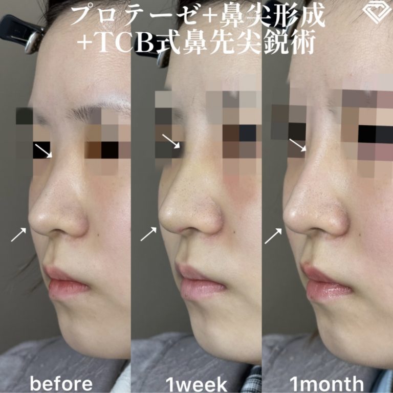 鼻プロテーゼ（隆鼻術）(担当医:森本 理一郎 医師)の症例写真1