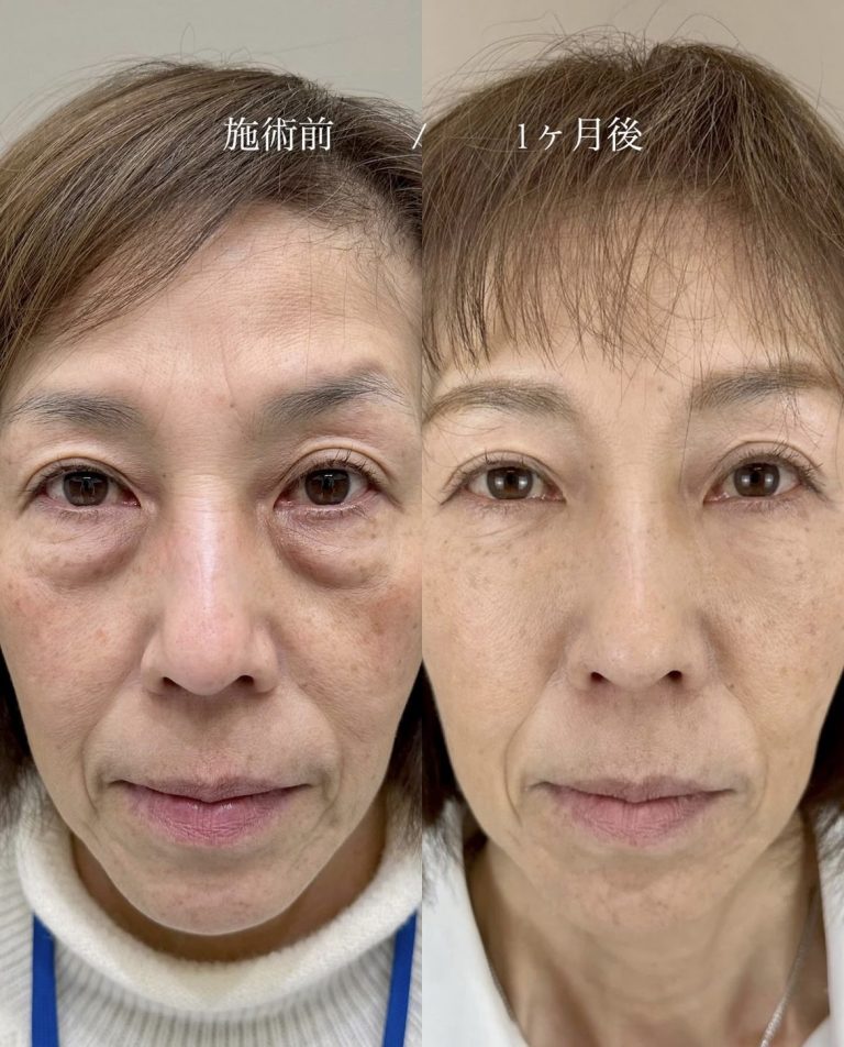 切らない目の下のクマ取り・目の下のたるみ（ふくらみ）取り(担当医:寺西 宏王 医師)の症例写真1