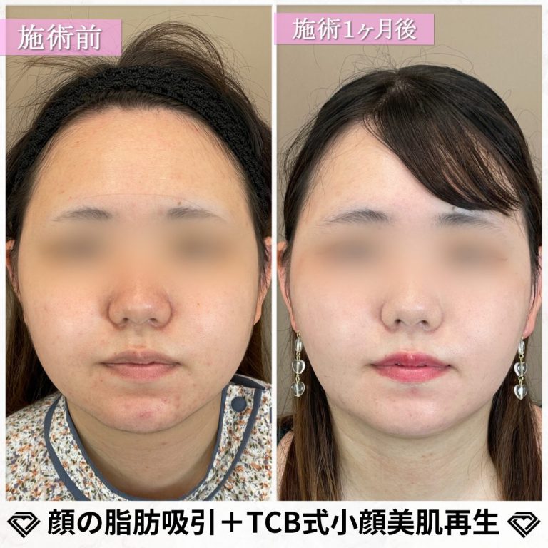 TCB式小顔脂肪吸引(担当医:篠永 宏行 医師)の症例写真1