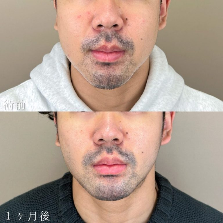 顔の脂肪吸引(担当医:山本 展生 医師)の症例写真1