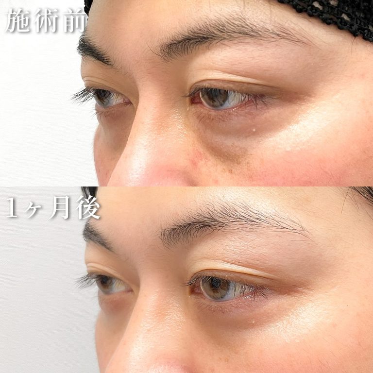 切らない目の下のクマ取り・目の下のたるみ（ふくらみ）取り(担当医:TCB 医師)の症例写真1