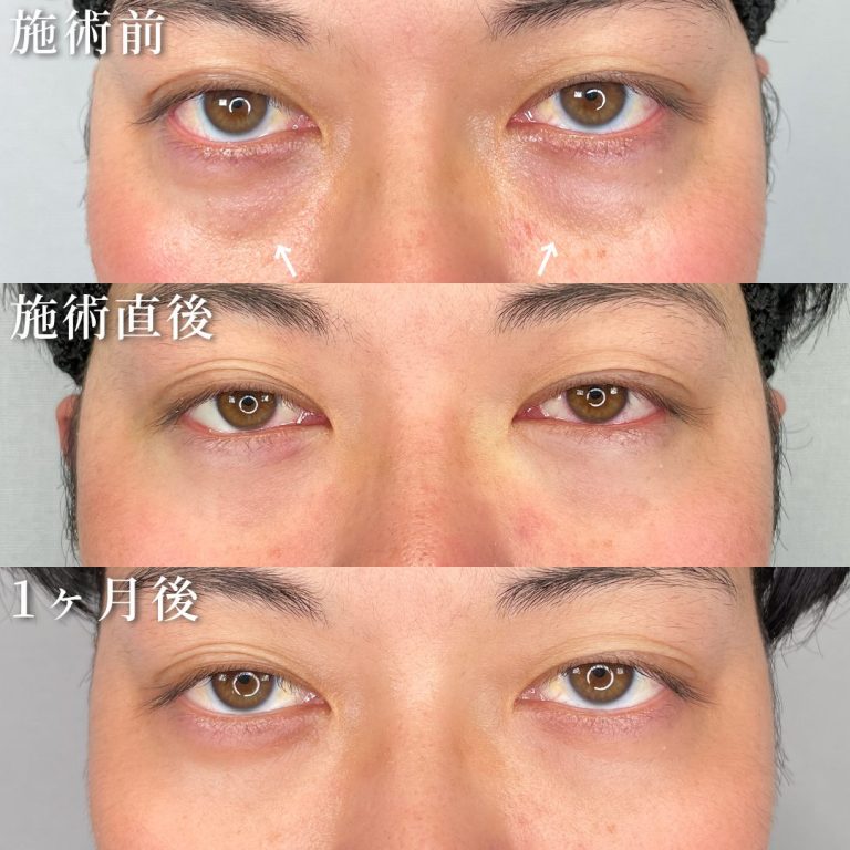切らない目の下のクマ取り・目の下のたるみ（ふくらみ）取り(担当医:TCB 医師)の症例写真2