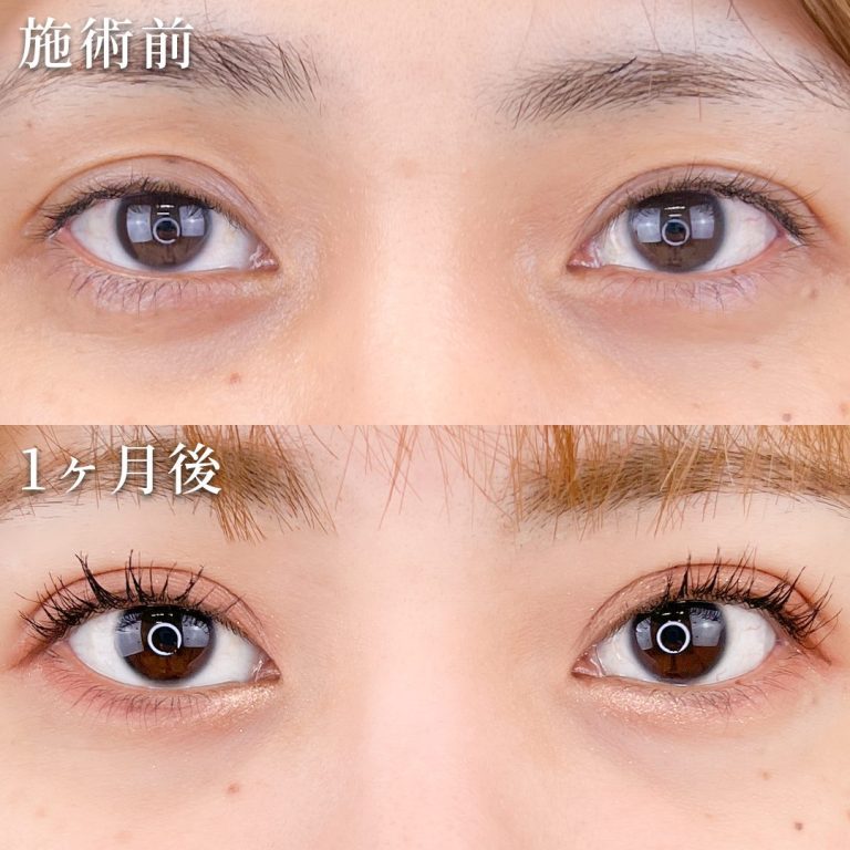 二重埋没法(担当医:TCB 医師)の症例写真1