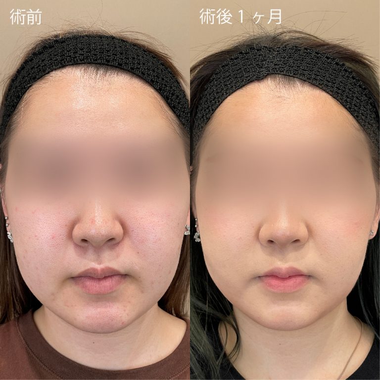 TCB式小顔脂肪吸引(担当医:鈴木 大路 医師)の症例写真1