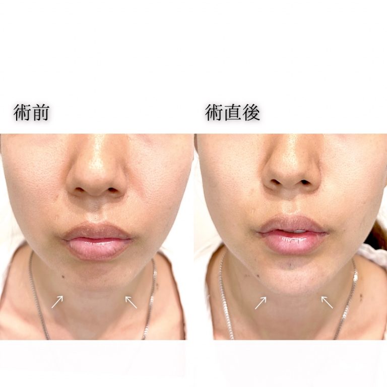 切らない顎形成 3D Eライン(担当医:三好 翔輝 医師)の症例写真1