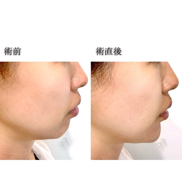 切らない顎形成 3D Eライン(担当医:三好 翔輝 医師)の症例写真2