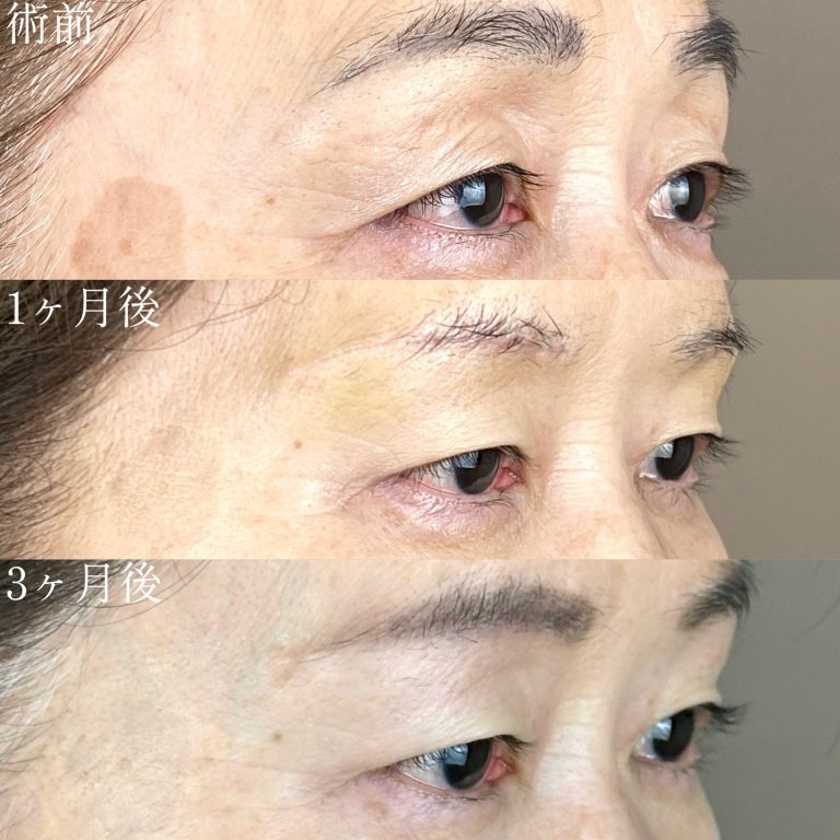 眉下リフト(担当医:森本 理一郎 医師)の症例写真4