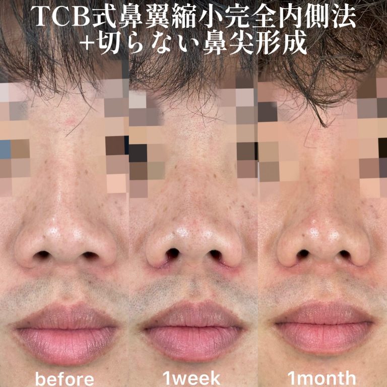 鼻尖形成完全閉鎖法（切らない鼻尖形成）(担当医:森本 理一郎 医師)の症例写真3