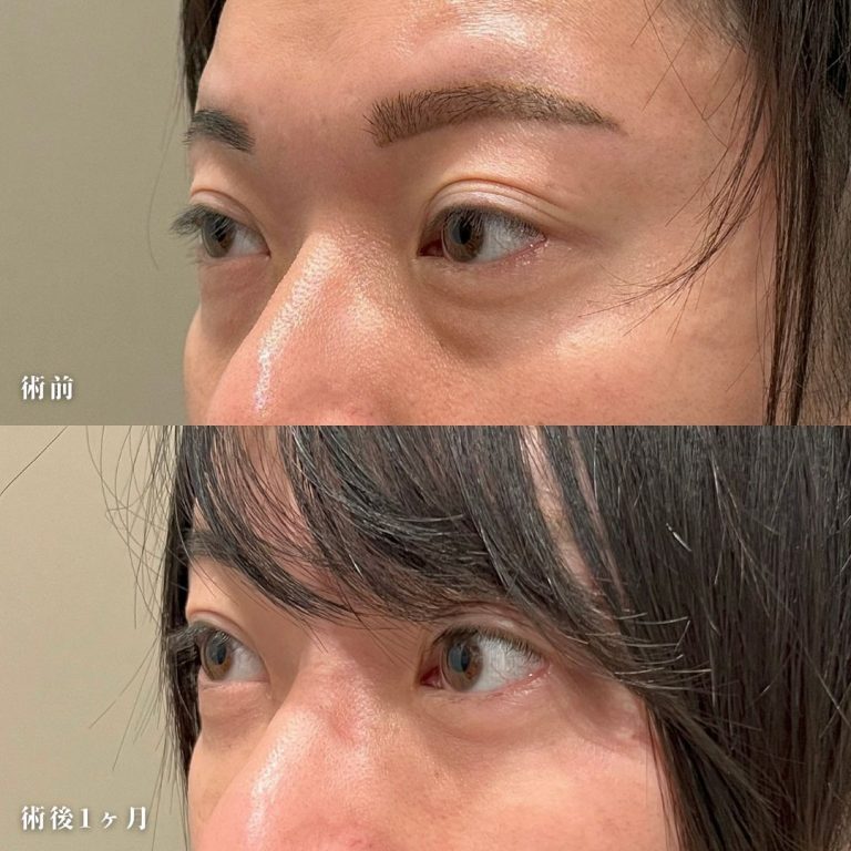 切らない目の下のクマ取り・目の下のたるみ（ふくらみ）取り(担当医:TCB 医師)の症例写真2