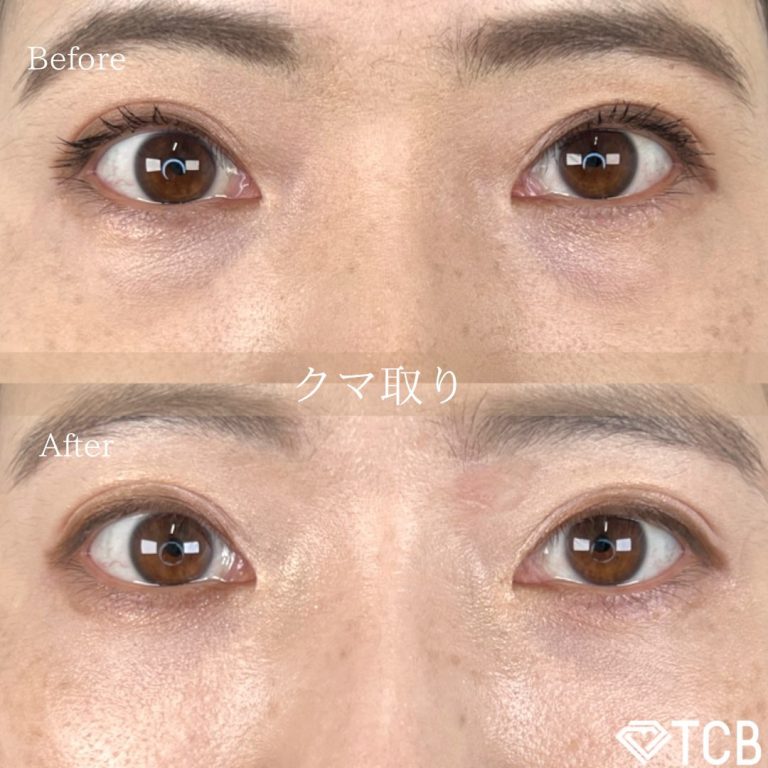 切らない目の下のクマ取り・目の下のたるみ（ふくらみ）取り(担当医:TCB 医師)の症例写真1