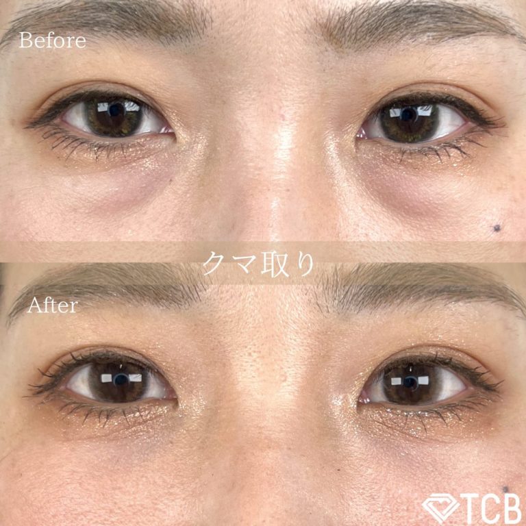切らない目の下のクマ取り・目の下のたるみ（ふくらみ）取り(担当医:TCB 医師)の症例写真1