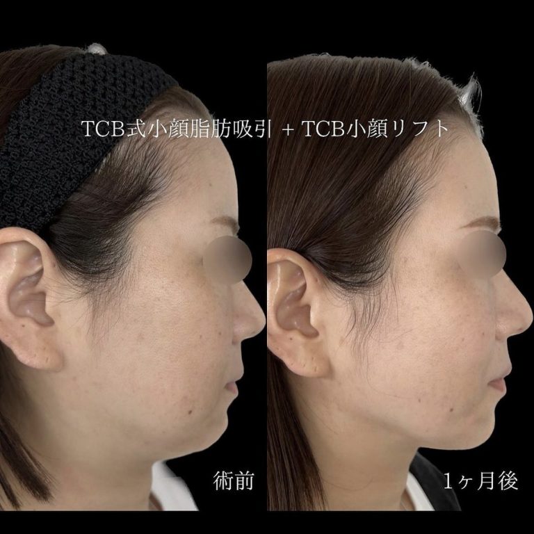 TCB式小顔脂肪吸引(担当医:TCB 医師)の症例写真1
