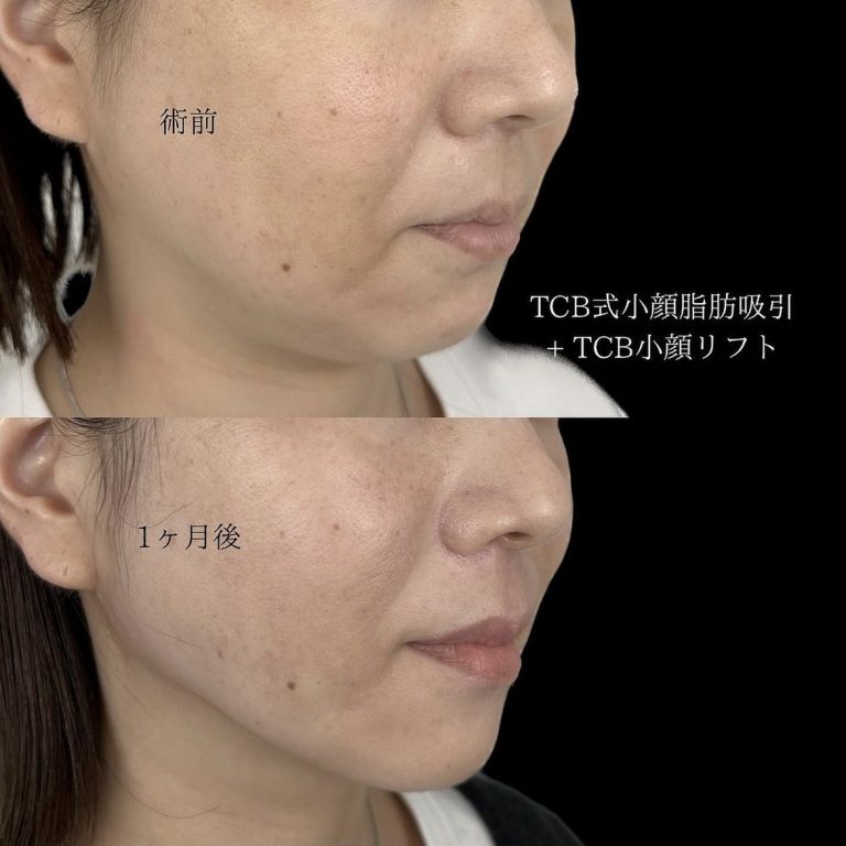TCB式小顔脂肪吸引(担当医:TCB 医師)の症例写真2