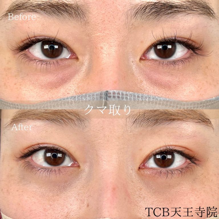 切らない目の下のクマ取り・目の下のたるみ（ふくらみ）取り(担当医:TCB 医師)の症例写真1