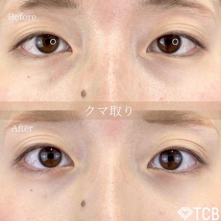 切らない目の下のクマ取り・目の下のたるみ（ふくらみ）取り(担当医:TCB 医師)の症例写真1