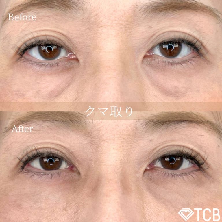切らない目の下のクマ取り・目の下のたるみ（ふくらみ）取り(担当医:TCB 医師)の症例写真1