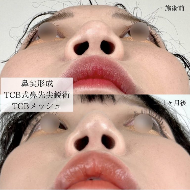 鼻尖形成(担当医:TCB 医師)の症例写真1