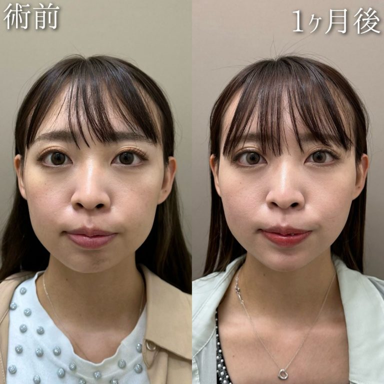 TCB式小顔美肌再生(担当医:中村 杏奈 医師)の症例写真1