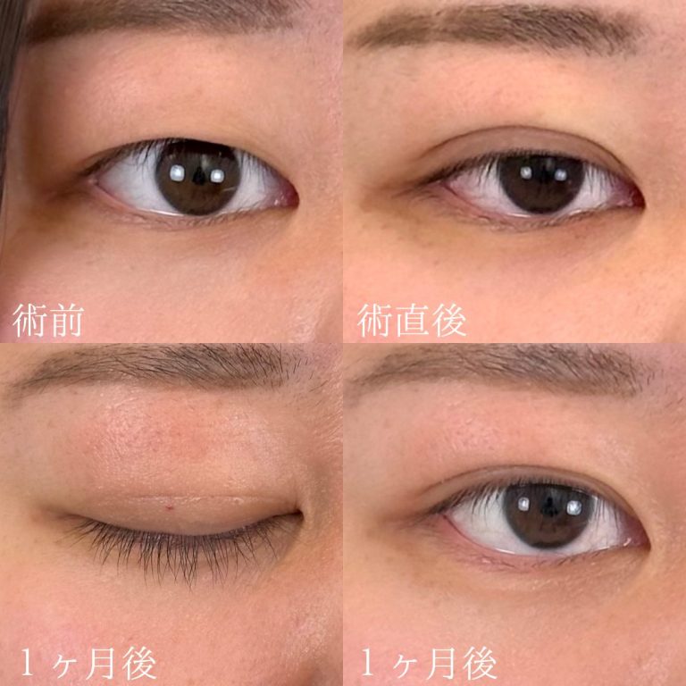 二重埋没法(担当医:TCB 医師)の症例写真1