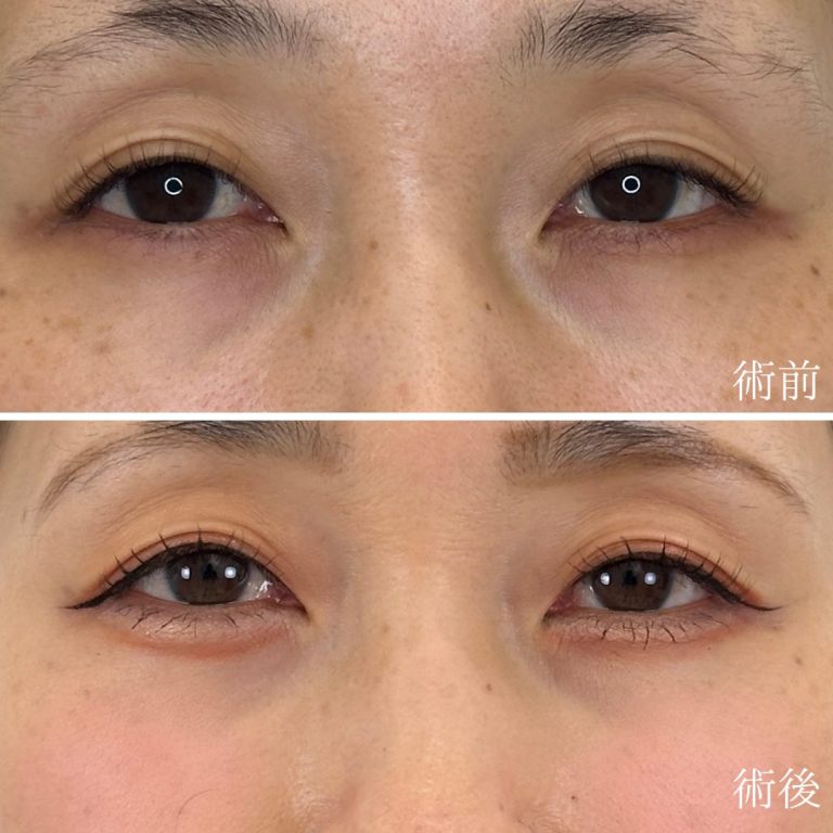 切らない目の下のクマ取り・目の下のたるみ（ふくらみ）取り(担当医:TCB 医師)の症例写真1