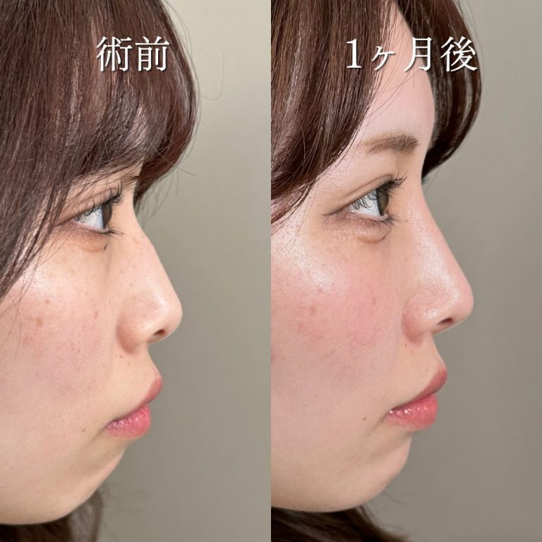 鼻プロテーゼ（隆鼻術）(担当医:中尾 聡一郎 医師)の症例写真2